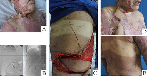 Figure 4 Case 3. A 48-year-old female patient had scar deformity in neck. (A) The scar before operation. (B) DSA showed that the distal end of the descending branch of the thoracodorsal artery is around the 9th rib. (C) The flap was harvested. The red line showed the length of vascular pedicle was about 21cm. (D) The appearance after operation. (E) The donor site healed with satisfactory appearance.