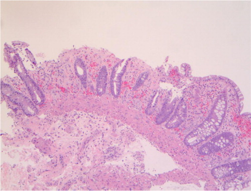 Fig. 3 Low-power photomicrograph (hematoxylin and eosin stain) of a biopsy of splenic flexure showing focal glandular dropout, small glands with mucin depletion, denudation of surface epithelium, stromal hemorrhage, and fibrosis.