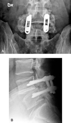 Figure 5:1 Instrumented fusion L4–L5 with bridging trabecular bone between transverse processes lateral to VSP implants. A. Anteroposterior view. B. Lateral vew.