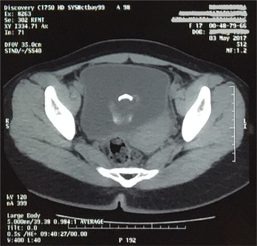 Figure 1 CT scan showing a mass mimicking a stone in the bladder.