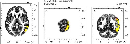 Figure 3 Voxel-wise statistical non-parametric map (SnPM) of sLORETA images in all patients (n=19) during imagery of an general anxiety scenario minus resting state acitivity compared to a general anxiety scenario minus the resting state acitivity in controls (n=15) at the 0.05 significance level after correction for multiple comparisons. Yellow/red shades indicate increased theta sources (red for P<0.1; yellow for P<0.05). Structural anatomy is shown in gray scale (A – anterior; P – posterior; L – left; R – right).