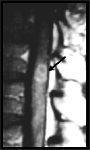 Figure 9 A 37-year-old man presented with paraplegia in the lower limbs and urinary incontinence. Thoracic spinal cord MRI demonstrated an intramedullary lesion with heterogeneous gadolinium-enhancement in the level of T12 (arrow). The patient underwent surgery, and the final diagnosis was PCM.