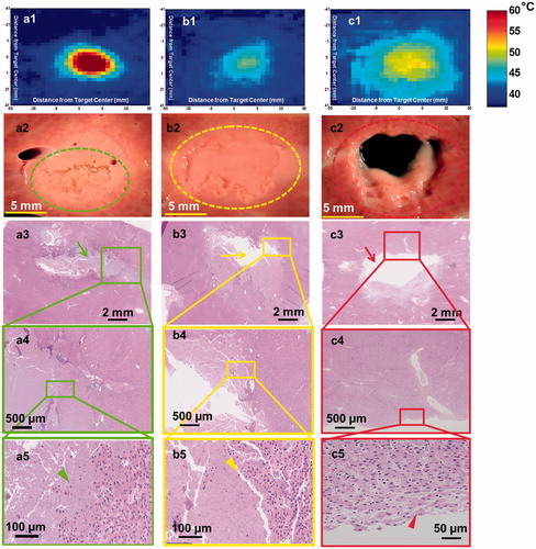 Figure 2. Lesions produced in ex vivo porcine liver tissue using sonication parameter sets F, A and D with their corresponding H&E stains are illustrated in a, b & c panels, respectively. These lesions display significantly different morphologies. a1. Thermal map showing temperatures greater than 60 °C in the focal region. a2. Shows a solid thermal lesion (green dotted circle) with mechanical disruption of tissue at the centre of the focal region, surrounded by whitening of tissue. a3. Shows H&E stain with green arrow pointing to the necrosed region of liver. a5. Arrowhead pointing to individual injured cells at the edge of the treatment region. b1. Thermal map displaying temperatures no greater than 50 °C at the focal region, with minimal or no temperature change surrounding this region. b2. Lesion consists of a paste-like tissue in the focal region (yellow dotted lesion) surrounded by a sharp boundary of intact tissue. b3. Shows area of missing tissue in the H&E stain due to loss of the paste during stain process. b4. Region of both intact and necroses tissue. b5. Yellow arrowhead points to hepatic cells partially or completely ruptured. c1. This lesion consisted of the greatest area of temperature, but did not have temperatures increase greater than 55 °C. c2. Displays a vacuolated lesion at the focal region (red dotted circle) with intact tissue around the lesion. c3. Red arrow shows region of vacuolated tissue with intact surrounding tissue. c4&5. Region of intact tissue and vacuolated tissue with red arrowhead pointing to the edge of the lesion that is intact post sonication.