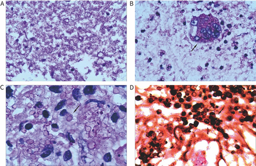 Figure 2 Histopathology and cytology of histoplasmosis. (A) Periodic acid-Schiff stain with many yeasts in bone lesion biopsy (original magnification ×400). (B) Periodic acid-Schiff stain with numerous yeasts in multinucleated giant cells (original magnification ×400). (C) Periodic acid-Schiff stain with a large number of yeasts inside and outside the cell (original magnification ×1000). (D) Gomori–Grocott methenamine silver stain showing intracellular yeast forms in bone biopsy (original magnification ×1000).