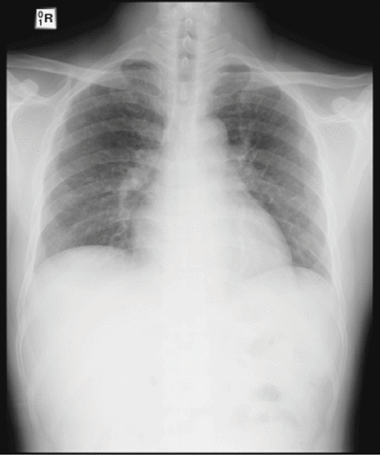 Figure 2. Follow-up chest radiograph indicated resolution of pneumonia after ten days of therapy.