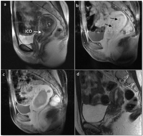 Figure 2. Magnetic resonance images before and after USgHIFU in a 33-year-old nulliparous woman with hypointense submucosal myoma and hypermenorrhea. (a) T2-weighted image before USgHIFU. Myoma volume of 51 cm³ and 6 cm maximum diameter occupying the whole uterine cavity. (b) T1-weighted contrast-enhanced image before USgHIFU. Myoma was highly vascularized with small areas of low vascularization (arrows). (c) T1-weighted contrast-enhanced image immediately after USgHIFU showed a non-perfused volume of 100%. (d) T2-weighted image 6 months after treatment. The myoma had completely disappeared with restoration of normal uterine anatomy. This patient achieved two full-term spontaneous pregnancies that ended in uncomplicated vaginal deliveries at 38.4 and 37 weeks. ICO, internal cervical os.