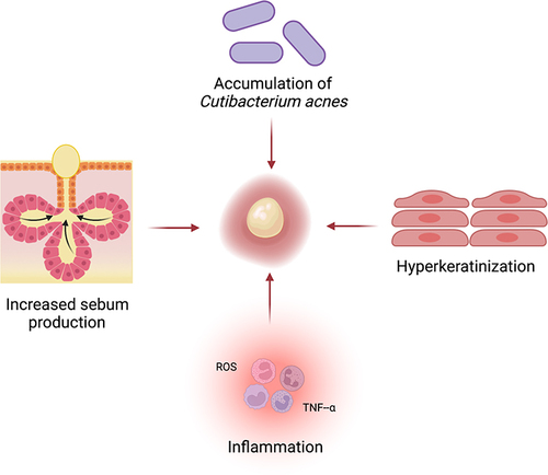 Figure 1 Acne pathogenesis. Interplay of increased sebum production, accumulation of C. acnes, hyperkeratinization, and inflammation resulting in the formation of comedones. Created with BioRender.com.