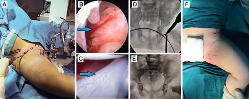 Figure 3. Arthroscopic technique demonstrating the portals (A), intra-articular pulvinar (B), hypertrophic ligamentum teres (C), intraoperative fluoroscopic image during incision of the transverse acetabular ligament (D), and intraoperative radiographic control for concentric reduction (E).