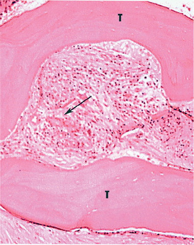 Figure 2. Histology. Evidence from the grafted area of new bone formation and residual necrotic bony spicules from the graft material.