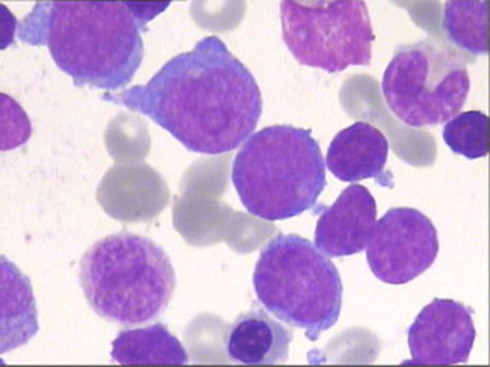 Figure 1. May–Grunwald–Giemsa-stained BM smear showing a mixed-cell population of large and small blasts.