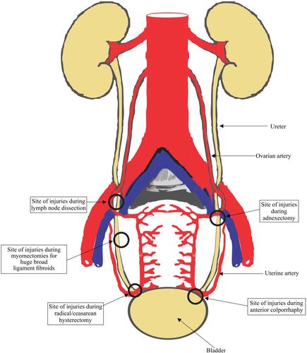 Figure 2 Showing the common sites of ureteral injuries.