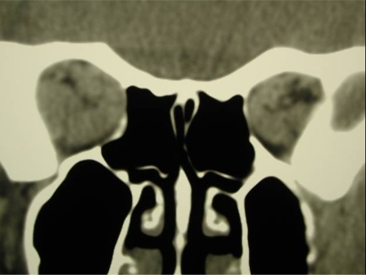 Figure 4 CT imaging of extraocular muscle enlargement at orbital apex.