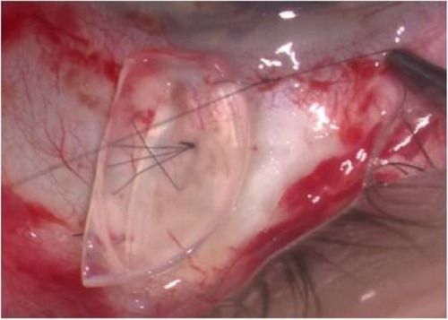 Figure 2 Intraoperative view of the gamma-irradiated cornea allograft.