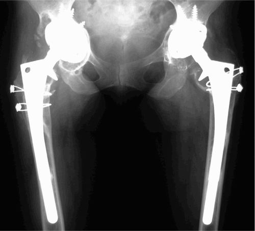 Figure 1D. The right hip was reconstructed in a similar fashion to the left hip at a later time.