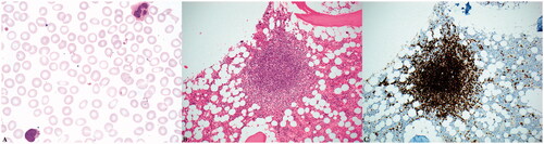 Figure 2. Microscopic examination of the patient’s peripheral blood smeared reveals atypical lymphocytes with villous morphology (A, 1000x magnification). Her bone marrow contained prominent lymphoid aggregates accounting for approximately 20% of the marrow’s cellularity (B, 200x magnification) that were composed of B-cells positive for CD20 by immunohistochemistry (C, 200x magnification).