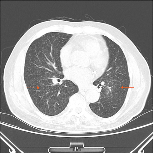 Figure 3 Chest CT showing: bronchiole lesions and multiple miliary foci in both lungs with pleural effusion and slightly thickened pleura. This combined with the medical history is consistent with the diagnosis of hematogenous disseminated pulmonary tuberculosis.