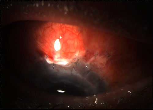 Figure 6 One-week post bleb revision with scleral patch.