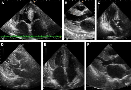 Figure 2 Echocardiography of the three presented cases.Notes: Parasternal long-axis views (A, C, and E) and apical four-chamber views (B, D, and F) are presented. (A and B) Case 1: granular sparkling appearance was seen in the interventricular septum (IVS), which was 11.5 mm in thickness. (C and D) Case 2: granular sparkling appearance was seen in the IVS and the lateral wall. The IVS of Case 2 was less thickened (9.8 mm in thickness), but the left ventricular wall exhibited diffuse hypertrophy with diastolic dysfunction (E/e′ 15.55) without valvular dysfunction. (E and F) Case 3: granular sparkling appearance was shown in the IVS and lateral wall, and the IVS was 13.0 mm in thickness.