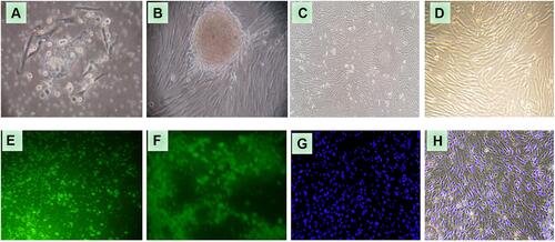 Figure 1 Growth of OS-SCs isolated from a single human osteosarcoma sample with its high grade and osteoblastic essential clinical characteristics obtained from biopsy before the chemotherapy treatment. (A) OS-SCs fibroblast-like cells grow 60% in 3rd passage; (B). OS-SCs fibroblast-like cells grow 90% confluent in 4th passage; (C) 90% confluent cell growth of OS-SCs in 5th passage 5; (D) 90% growth of OS-SCs in 6th passage; (E) OS-SCs positively expressed by CD133+ expression; (F) OS-SCs positively expressed by CD44+ expression; (G) OS-SCs stained with DAPI; (H) The comparison between normal cells and cells stained with DAPI.