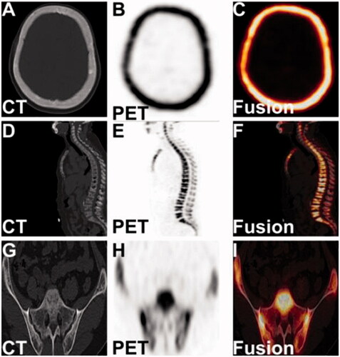Figure 3. The tomography images of the skull, lumbar spine, and bilateral ilium in 18F-NaF PET/CT imaging.
