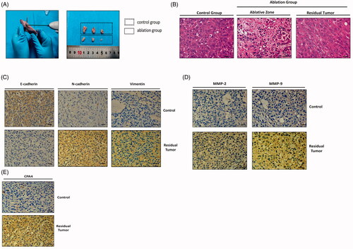 Figure 10. Expression of EMT markers, metastasis-associated proteins and CPA4 in insufficient ablation of xenograft tumor model. (A) Implementation of insufficient microwave ablation on xenograft mice. Ablation power was 5 W with a 30 s duration. Ten days after ablation, the representative images of the isolated tumors from sacrificed mice were presented. (B) Representative images of ablation of different sites, HE staining, Scale bars, 50 µm. In the sufficient ablation zone, the nucleus were pyknosis and fragmentation, the cytoplasm was eosinophilic. Cells in the insufficient ablation zone showed spindle changes, which might result in EMT process. (C) Representative images of E-cadherin, N-cadherin, and Vimentin staining in the control and ablation groups. Compared with the control group, the expression of E-cadherin was lower in residual tumors, while the expression of N-cadherin and Vimentin was higher in residual tumors. Scale bars, 50 µm. (D) Representative images of MMP-2 and MMP-9 staining in the control and ablation groups. Compared with the control group, the expression of MMP-2 and MMP-9 was higher in residual tumors. Scale bars, 50 µm. (E) Representative images of CPA4 staining in the control and ablation groups. Compared with the control group, the expression of CPA4 was higher in residual tumors. Scale bars, 50 µm. Presented data were representative one from three independent experiments.