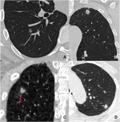 Figure 3 Patients with pulmonary cryptococcosis presented as solitary solid nodules. (A) Axial CT image in a 48-year-old asymptomatic man shows a round and well-defined nodule with small bronchi located in the right upper lobe. (B) Coronal CT image in a 54-year-old asymptomatic man shows a round and well-defined nodule with vacuole located in the left upper lobe. (C) Coronal CT image in a 50-year-old asymptomatic man shows an ill-defined nodule with a satellite lesion (red arrow) located in the right upper lobe. (D) Axial CT image in a 49-year-old asymptomatic woman shows an oval nodule with halo sign located in the left upper lobe.