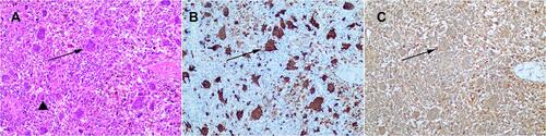 Figure 2 HE staining immunohistochemical staining of UCOGCP (A) HE staining (B) Immunohistochemical staining for CD68 (C) Immunohistochemical staining for vimentin. Triangle marks tumor cells solid arrow marks osteoclast-like giant cells.