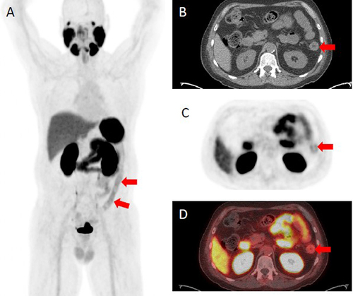 Figure 7 [18F]DCFPyL PET/CT demonstrating abnormally increased uptake in the descending colon (identified by red arrows), sigmoid colon, and rectum corresponding to findings on endoscopy. (A) [18F]DCFPyL PET/CT uptake in the descending colon on a coronal plane. (B) Axial CT Image with arrows identifying active inflammation in the descending colon. (C) Axial PET Imaging arrows identifying active inflammation in the descending colon. (D) Axial [18F]DCFPyL PET/CT fusion imaging identifying active inflammation in the descending colon.