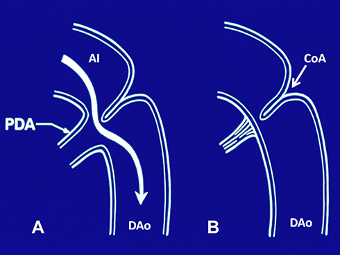 Figure 1 Diagrammatic portrayal of the flow from the isthmus to the descending aorta in coarctation of the aorta with ductus open (A) and closed (B). When the ductus is open, the posterior shelf of aorta is bypassed and symptoms of obstruction are relieved. Adapted with permission from Rao PS, Solymar L. Transductal balloon angioplasty for coarctation of the aorta in the neonate: Preliminary observations. Am Heart J. 1988;116(6, Part 1):1558–1563.Citation70 doi: 10.1016/0002-8703(88)90,743–0.