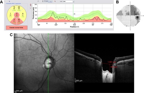 Figure 11 Structural and functional findings in a glaucomatous eye in percentile group 3 of the HVOC (mean =1,390 µm, mean MD =−10.40 (1.4) dB). (A) Circumpapillary RNFLT; (B) standard automated perimetry grayscale map; (C) B-scan of the largest vertical optic disc cup and length and depth used to calculate the HVOC.