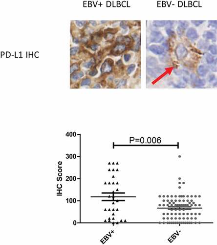 Figure 3. PD-L1 was over-expressed in EBV+ DLBCL. Red arrow highlighted scattered macrophages express PD-L1