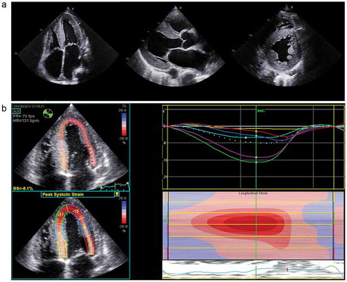 Figure 1. Transthoracic echocardiogram (TTE) of a patient with cardiac ATTR CM. TTE demonstrating concentric left ventricular hypertrophy (left to right) 4 Chamber view, parasternal and parasternal short axis view.4 Chamber global longitudinal strain demonstrating a ‘bull’s eye pattern’, characteristic of cardiac amyloidosis