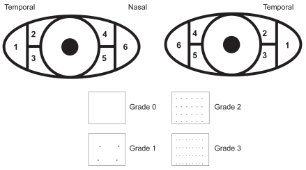 Figure 2 Conjunctival regions and staining grades.