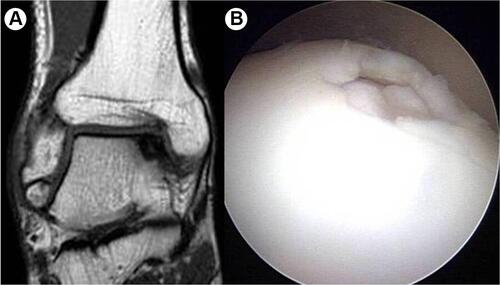 Figure 2 (A and B) Osteochondral lesion of the talar dome accompanied by chronic ankle instability.