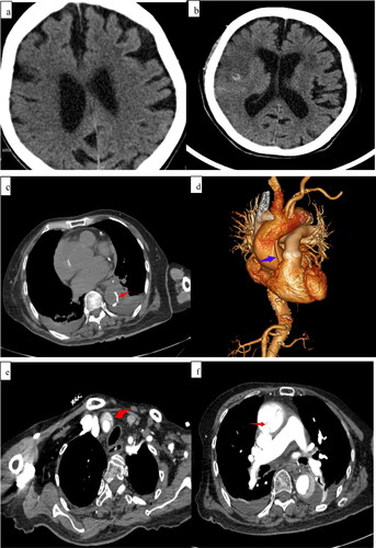 Figure 1. (a) Computed tomography (CT) performed before intravenous thrombolysis (IVT) shows old lacunar infarctions bilaterally in the area under the cortex of the head. (b) Head CT shows low-density foci in the right frontal and temporal lobes with minor hemorrhaging (no space-occupying effect) on the second day after IVT. (c) Chest CT shows inward displacement of the calcified plaques in the thoracic aortic arch (arrow) and suspicious double lumens from the aortic arch to the descending aorta, suggesting aortic dissection (AD). (d) CT angiography of the thoracoabdominal aorta shows a thoracoabdominal AD (DeBakey type I), with the AD extending from the aortic root to the brachiocephalic trunk (e) and then to the right common carotid artery. (f) Intimal slices split the lumen into two cavities in the aortic arch.