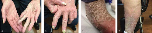 Figures 4, 5, 6, and 7. show the crusted scabies rash – thick, hyperkeratotic, crusted, plaque like scaly lesions of the palms, finger webs and shins