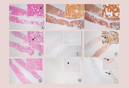 Figure 1. Biopsy samples of hepatocellular adenomas.β-catenin exon-3-mutated hepatocellular adenoma: thick trabeculae with mild nuclear atypia and pseudo-gland (arrow) are frequently observed (A). Strong diffuse staining for glutamine synthase (B), as well as nuclear translocation of β-catenin (C), when present, enable diagnosis. Inflammatory hepatocellular adenoma with sinusoidal dilatations, inflammatory foci and isolated arteries (arrow) (D). No glutamine synthase expression is observed (E). Immunostaining with amyloid A (SAA) shows strong cytoplasmic staining; normal adjacent liver in the upper part is negative for SAA (F). HNF1A-inactivated adenoma with tumor steatosis (G). Glutamine synthase (H) is negative or weak (similar to adjacent nontumor liver with perivenular staining, arrow). In contrast to the adjacent nontumor liver (I, arrows), HNF1a-inactivated adenoma characteristically lacks L-FABP staining in the tumor (I).SAA: Serum amyloid A.