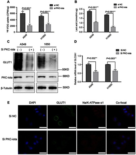 Figure 2 PKC-iota knockdown reduces 18F-FDG uptake and GLUT1 expression. (A) A549 and H1650 cells were transfected with Si NC or Si PKC-iota for 72 h, after which time 18F-FDG uptake of the indicated cells was detected (CPM: counts per minute). (B) A549 and H1650 cells were transfected with Si NC or Si PKC-iota for 72 h, after which time lactic acid production of the indicated cells was detected. (C) A549 and H1650 cells were transfected with Si NC or Si PKC-iota for 72 h. Then, the cell lysates were immunoblotted with antibodies against PKC-iota and GLUT1. β-Actin served as the loading control. (D) A549 and H1650 cells were transfected with Si NC or Si PKC-iota for 36 h. The mRNA levels of SLC2A1 were analyzed by real-time PCR. (E) A549 cells were transfected with Si NC or Si PKC-iota for 72 h before IF staining. Staining for DAPI (blue), GLUT1 (green), Na/K-ATPase α1 (red) and the overlays of three channels (the membrane localization of GLUT1 are shown in yellow) are shown in the first, second, third, and fourth lines, respectively (scale bar, 25 μm).