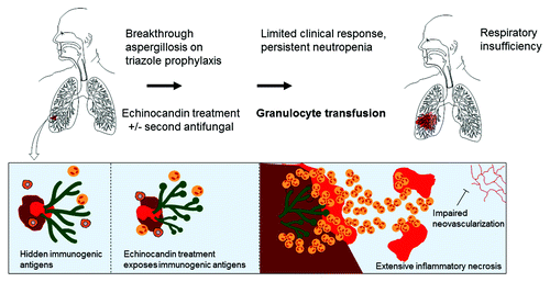 Figure 1. A depiction of the mechanism of lung injury in the setting of GTX in genetically predisposed patients with established breakthrough aspergillosis treated with cell-wall damaging agent or IRIS.