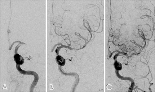 Figure 2 (A) Digital subtraction angiography (DSA), left internal carotid artery injection, anteroposterior (AP) view, showing proximal left middle cerebral artery (MCA) M1 occlusion with intraluminal filling defect due to thrombosis. (B) DSA, AP view, showing a 4-mm × 40-mm Solitaire X (Medtronic) stent-retriever (SR) un-sheathed in the affected MCA with reopening of the vessel. (C) DSA, AP view, post-thrombectomy, showing successful recanalization and restoration of blood flow.