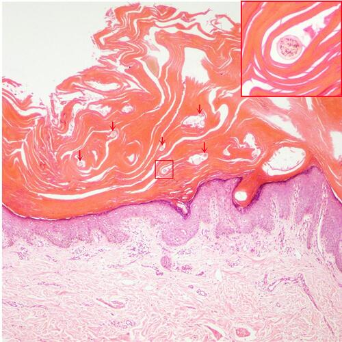 Figure 3 Histology (hematoxylin and eosin, ×100 magnification) shows severe lamellar hyperkeratosis, mild hypertrophy of the spinous layer, and vacuolated degeneration of some spinous cells. In the stratum corneum, there were some cross-sections of hair shaft (arrows). One of those structures was highlighted and magnified in the upper right corner (red box).