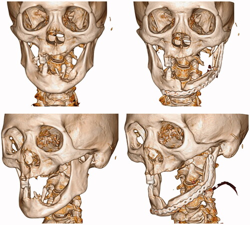 Figure 6. Pre-operative and post-operative computed tomographies (3D reconstructed).