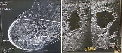 Figure 3 (A) Mammogram shows recurrence of cystic lesions in the breast and partial resolution of edema shunt in the breast tissue. (B) Cystic lesion recurrence on ultrasound.