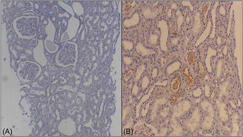 Figure 2.  Immunohistochemical staining for HBsAg. Nine tissues were not stained by HBsAg as like A, one case (B) was stained by anti-HBsAg in the cytoplasm of tubular cells.