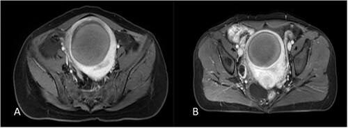 Figure 6. Contrast-enhanced MRI obtained from a patient with uterine fibroids in non-recurrence group. (A) One day post-USgHIFU imaging showed the fibroid was completely ablated. (B) 6-month post-USgHIFU imaging showed a shrinkage of 30% of the treated fibroid without local recurrence.