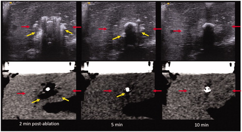 Figure 8. US (top) vs. CT (bottom) images of the MW ablation zone post-procedure. Yellow arrows describe the zone of gas while red arrows indicate the hypoechoic/hypoattenuating zone. (Note that the hypoattenuating zone is subtle on CT.) Note the relatively rapid resolution of the zone of visible gas on both ultrasound and CT.