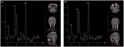 Figure 2. Ordinary patient during fever and after recovery. (a) Proton MR spectra image of the cerebellum obtained in a 26-year-old woman with a cold during fever. The image shows a high Cho peak. (b) Proton MR spectra image of the cerebellum obtained in the same woman after recovery. The image shows a normal Cho peak.
