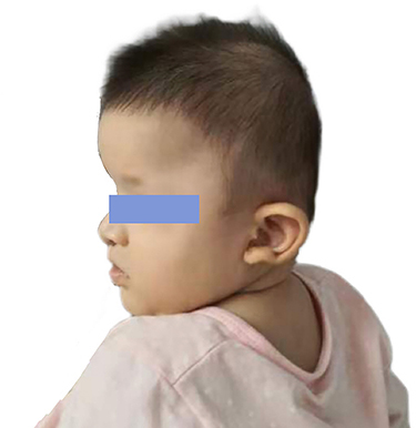 Figure 1 Distinctive facial characteristics of Patient 1 with Mowat-Wilson syndrome. The patient shows characteristic facial features of Mowat-Wilson syndrome, including wide eyebrows, a slightly wider distance between the eyes, and a prominent rounded nose tip and uplifted ear lobes with a central depression.