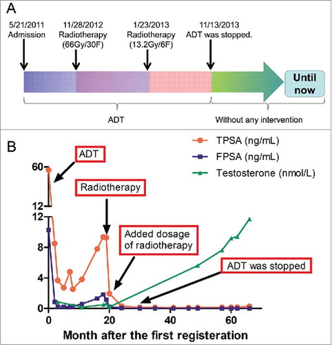 Figure 2. Treatment regimen and laboratory test results during and after treatment for prostate cancer. (A) Therapeutic schedule. (B) Serum levels of TPSA, FPSA, and testosterone during and after treatment. FPSA, free prostate-specific antigen; TPSA, total prostate-specific antigen. ADT: Androgen deprivation therapy.