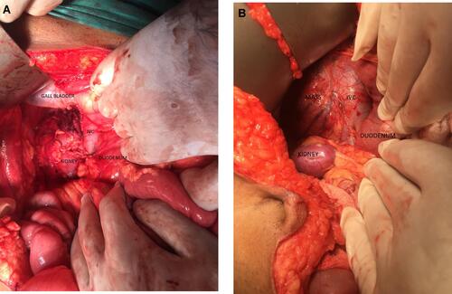 Figure 1 (A, B) Per operative pictures showing tumor with adjacent structures.